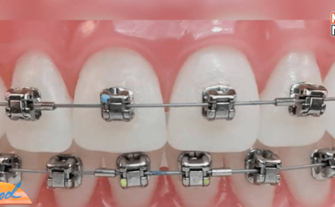 เตือนภัยจัดฟันเถื่อนเสี่ยงติดเชื้อ HIV