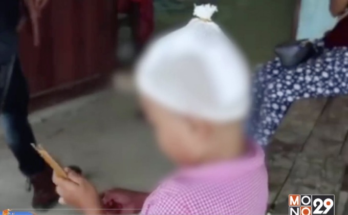 สุนัขจรจัดกัดศีรษะเด็กหญิง 4 ขวบเย็บ 10 เข็ม