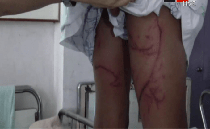 เด็กถูกพิษแมงกะพรุนบริเวณทะเลแหวก จ.กระบี่