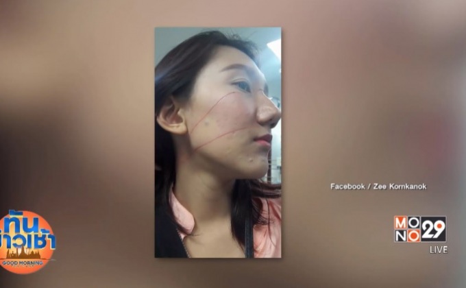 อุทาหรณ์! สาวนั่งซ้อน จยย.ถูกเบ็ดพันหน้า