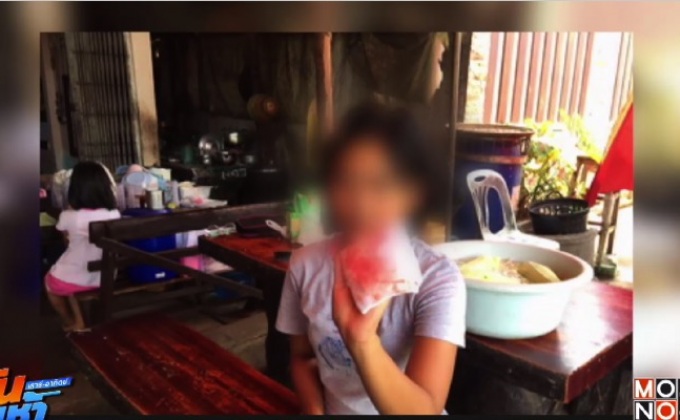 แพทย์ยัน “เหงื่อเป็นเลือด” รักษาหายได้ ไม่ติดต่อ