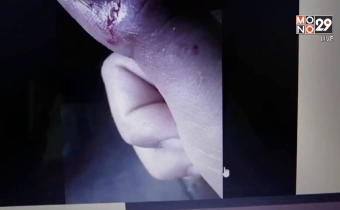 สอบสวนวินัยครูใช้หวายตีเด็กจนเป็นแผล