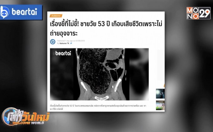 ชายวัย 53 ปี เกือบเสียชีวิตเพราะไม่ถ่ายอุจจาระ