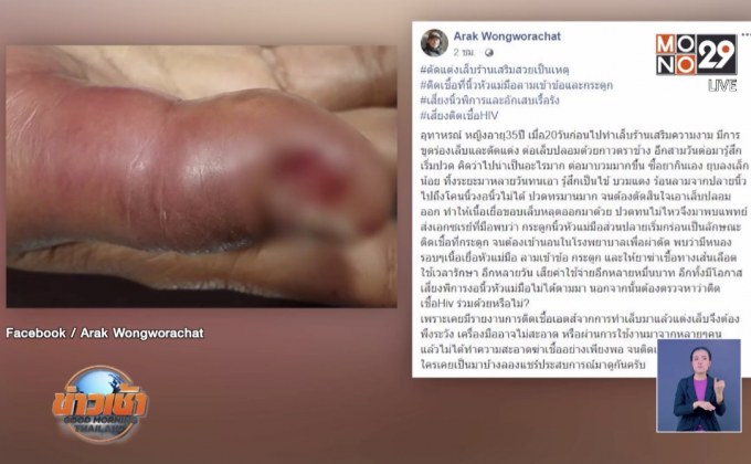 เตือนสาวต่อเล็บ ติดเชื้อลามถึงกระดูก