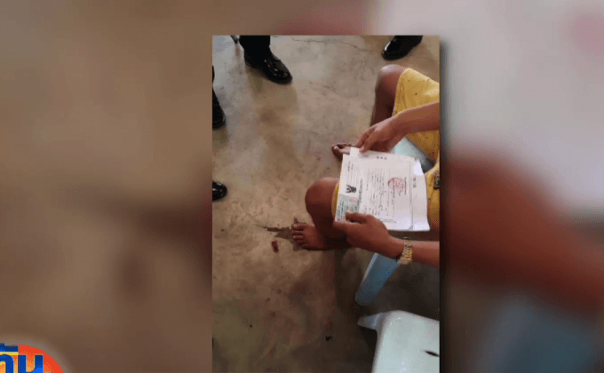 หนุ่มหัวใสทำนิ้วปลอม หวังรอดเป็นทหาร