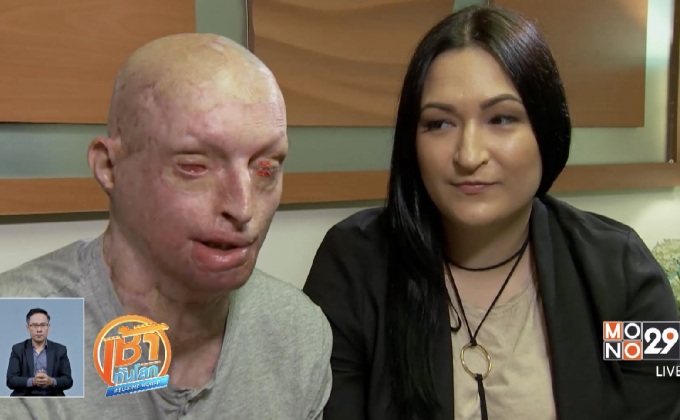 เหยื่อสาดน้ำกรดในอังกฤษเผยประสบการณ์เลวร้าย