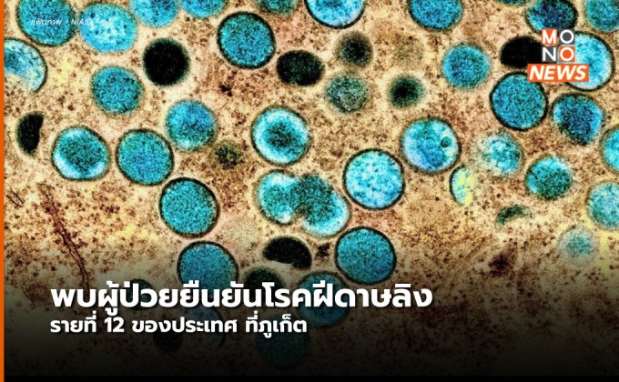 พบผู้ป่วยโรคฝีดาษลิงรายที่ 12 ของไทย