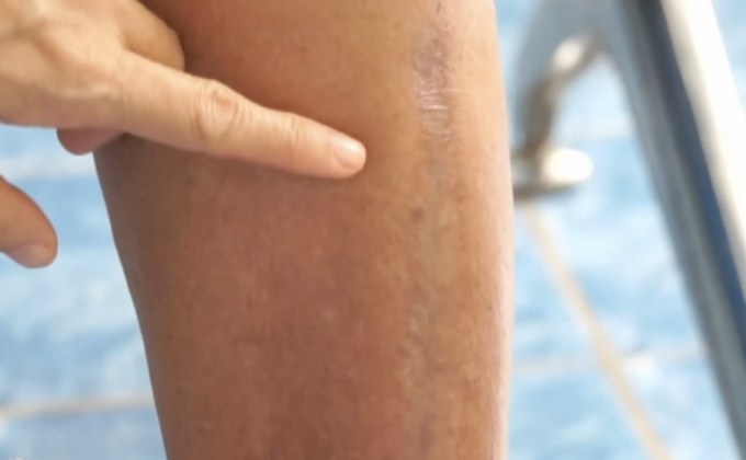 สั่งเฝ้าระวังโรคเนื้อเน่า พบผู้ป่วยสูงสุดในรอบ 3 ปี