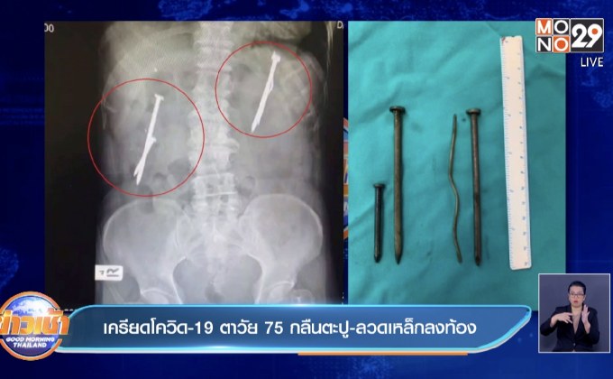 เครียดโควิด-19 ตาวัย75 กลืนตะปู-ลวดเหล็กลงท้อง