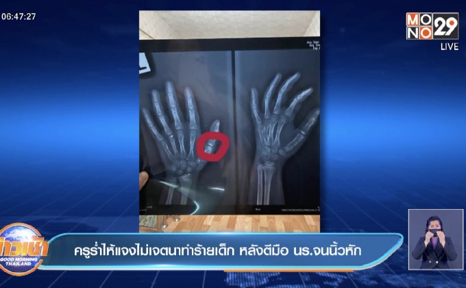 ครูร่ำไห้แจงไม่เจตนาทำร้ายเด็ก หลังตีมือ นร.จนนิ้วหัก