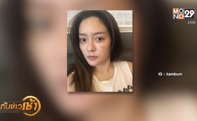 “แก้มบุ๋ม” หวิดเสียโฉมถูกแมวข่วนหน้า แย้มหัวใจไม่ว่าง