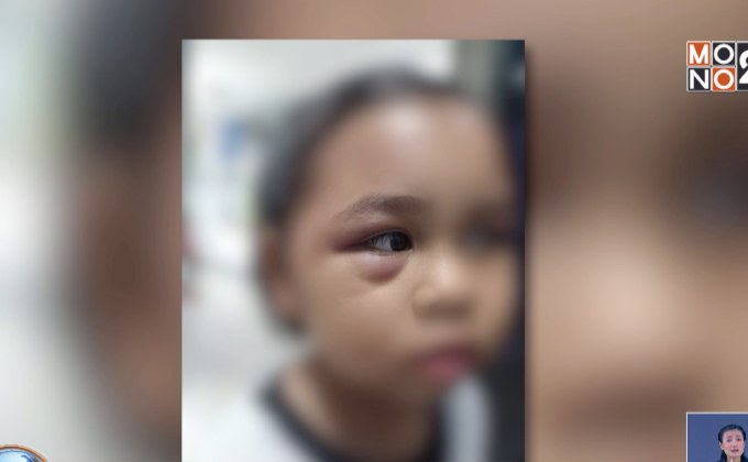 เมืองพัทยา เร่งช่วยเหลือด.ญ 7 ขวบถูกครูตีตาบวม