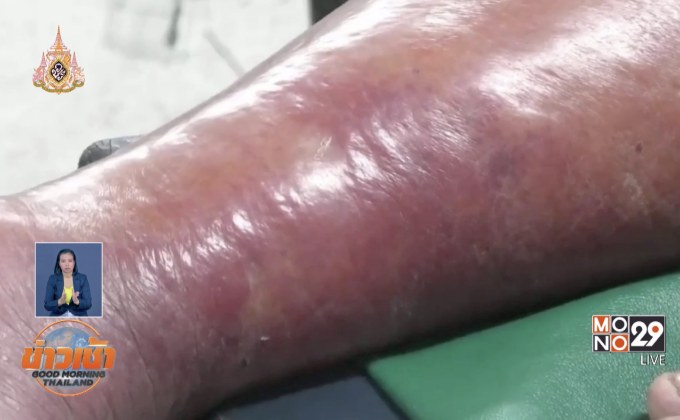 ​สั่งสอบปมพบ “ผู้ป่วยโรคเนื้อเน่า” 26 ราย จ.น่าน