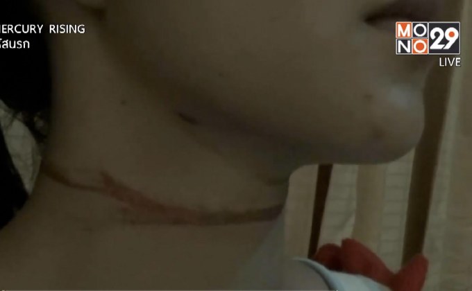 หญิงอายุ 18 ปี ร้องเรียนสื่อถูกสายไฟเกี่ยวคอ
