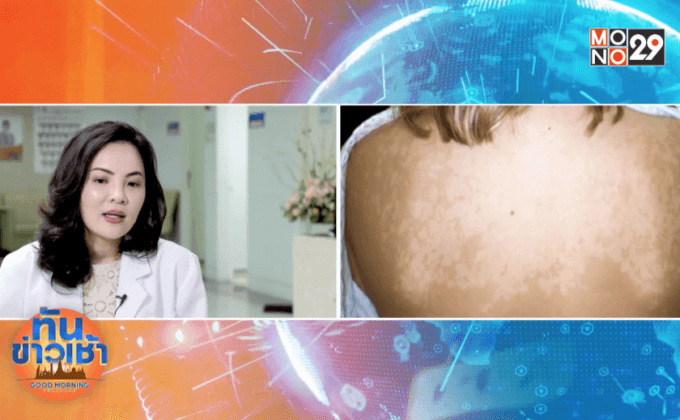 รู้ทัน!อันตรายจากแสงแดด