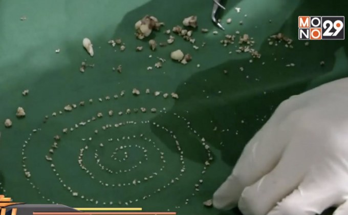 แพทย์อินเดียพบเด็กมีฟันกว่า 500 ซี่