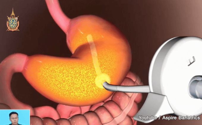 อุปกรณ์ลดน้ำหนักด้วยการ “ระบายอาหาร”