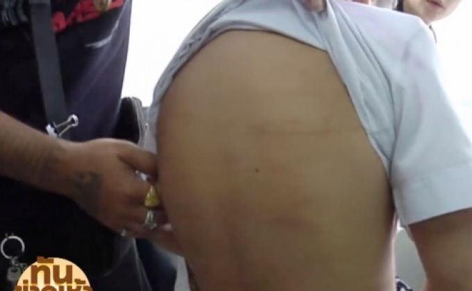 พาเด็กถูกใช้ไม้พลองตี 99 ที เข้าพบจิตแพทย์