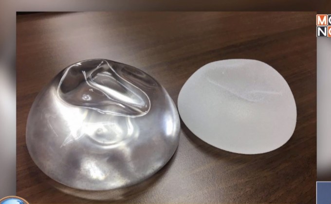 อย.ขออย่าตระหนกซิลิโคนเสี่ยงโรคมะเร็ง