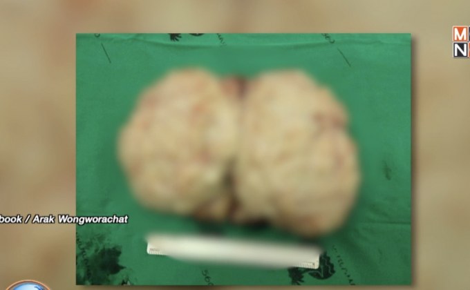 แพทย์ รพ.สิชล พบเนื้องอกมดลูกขนาดใหญ่ 20 เซนติเมตร