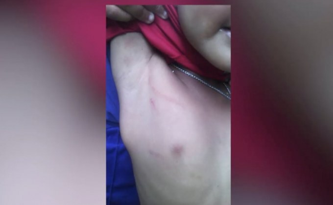 ผู้ปกครองพาลูกแจ้งความ ถูกครูตีจนผวา