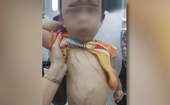 เตือนภัยพี่เลี้ยงโหดทำร้ายเด็ก 1 ขวบสาหัส