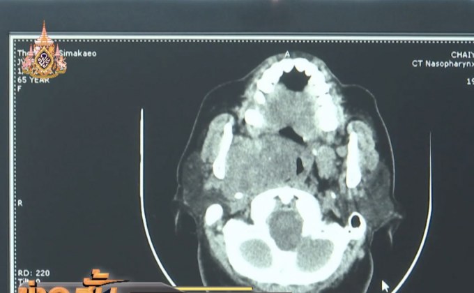 มข.คิดค้นนวัตกรรม “ปทุมรักษา” โรคมะเร็งเต้านม