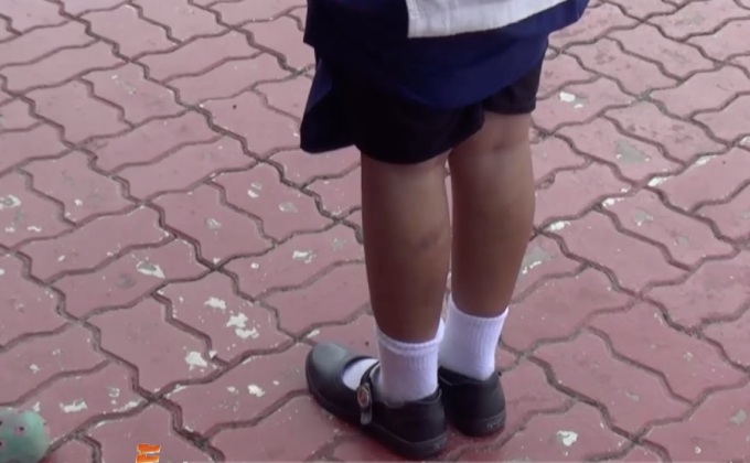 แม่ร้องเรียนครูลงโทษเด็กเกินกว่าเหตุ