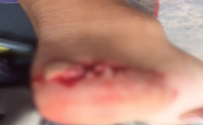 ผู้ว่าฯภูเก็ต ยืนยัน ปลาที่กัดนักท่องเที่ยวไม่ใช่ฉลาม