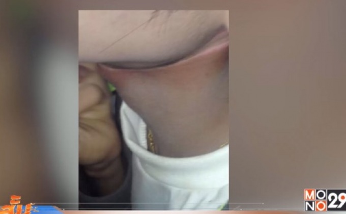 ร้องตรวจสอบสายเคเบิลเกี่ยวคอบาดเจ็บ จ.ลำปาง