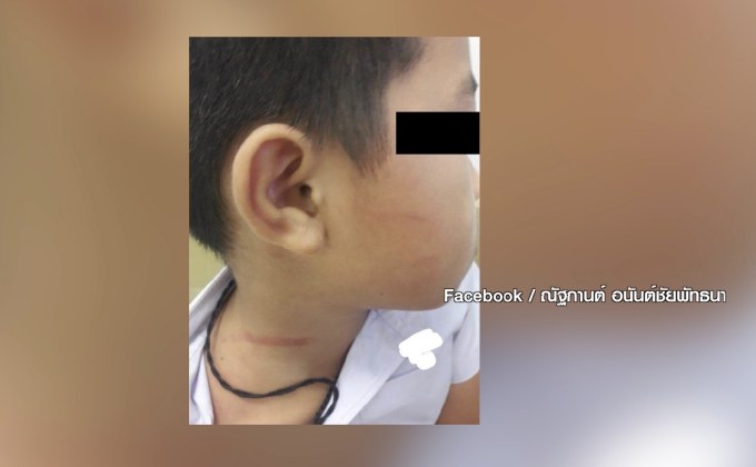 ผอ.ตบ “เด็กพิเศษ” แก้วหูทะลุ