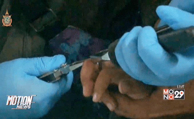 เด็กชายใส่แหวนจนเลือดคลั่ง