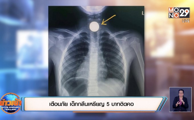 เตือนภัย เด็กกลืนเหรียญ 5 บาทติดคอ