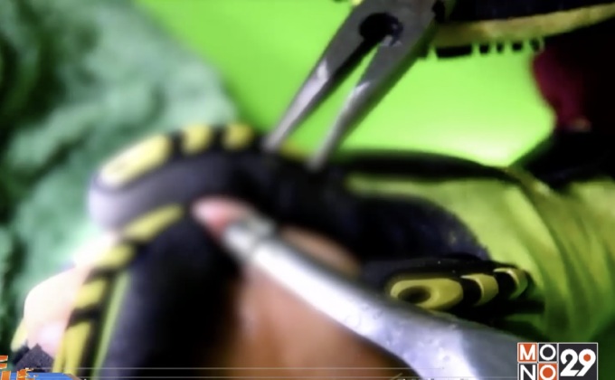 ช่วยเด็ก 13 ปีแหวนเหล็กติดนิ้วจนบวมเป่ง