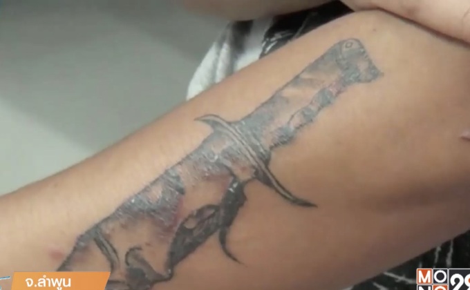 แห่แจ้งความ ร้านสักเมืองลำพูนทำแผลพุพอง