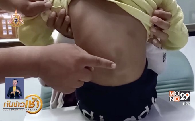 พ่อเลี้ยงอ้างทุบตีลูกวัย 5 ขวบ เพราะขโมยของ