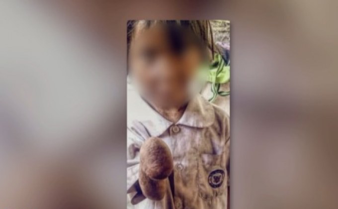 วอนช่วย เด็ก 4 ขวบข้อมือขาด ยากจน